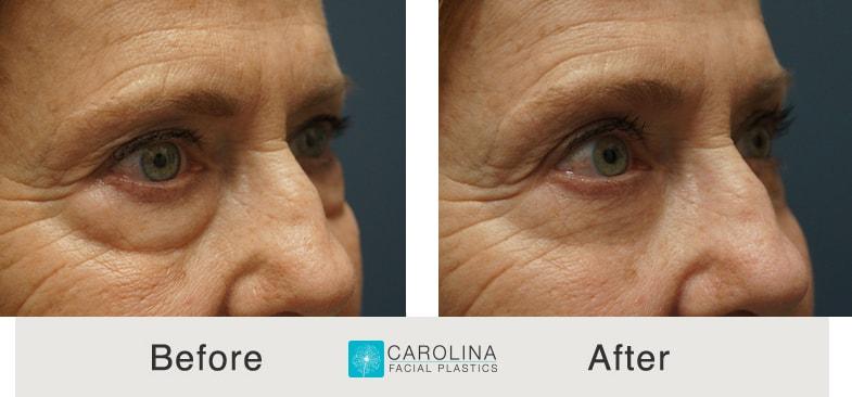 Carolina Facial Plastics eyelid lift result — Charlotte, NC