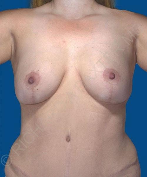 Mommy Makeover after at PHASE Plastic Surgery in Mountlake Terrace, WA