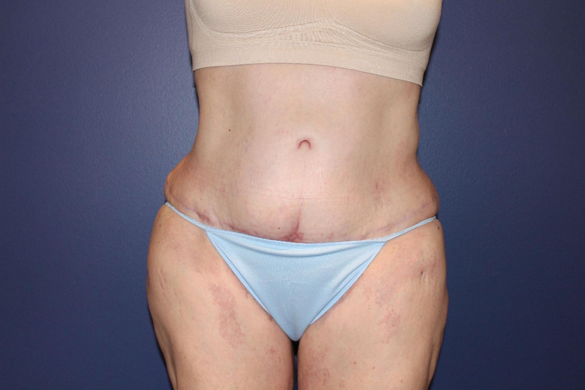 PHASE Plastic Surgery tummy tuck after — Mountlake Terrace, WA