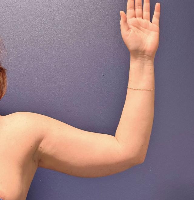 Liposuction before at PHASE Plastic Surgery in Mountlake Terrace, WA