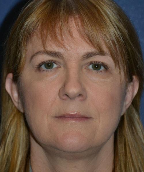 PHASE Plastic Surgery brow lift after — Mountlake Terrace, WA