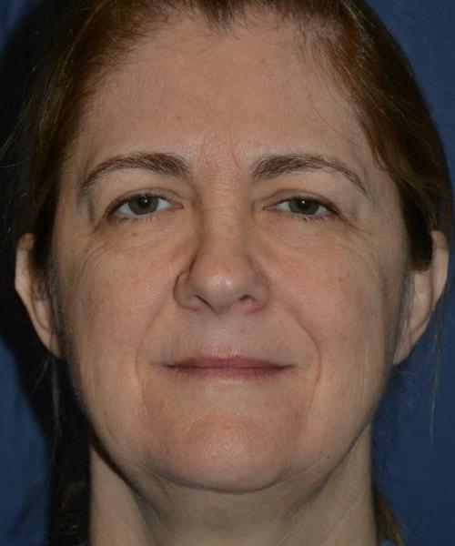 Brow Lift before at PHASE Plastic Surgery in Mountlake Terrace, WA