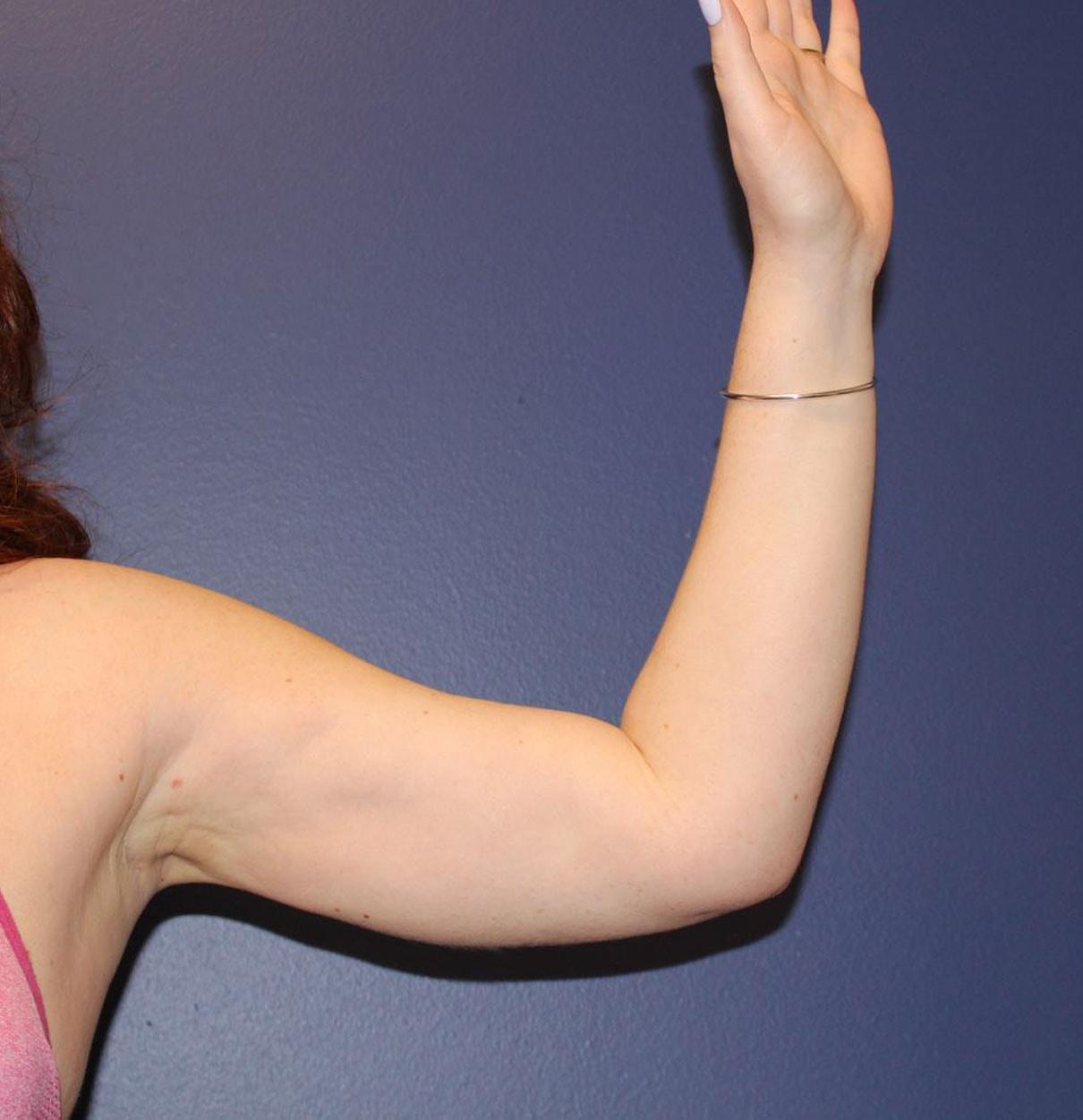 PHASE Plastic Surgery liposuction after — Mountlake Terrace, WA