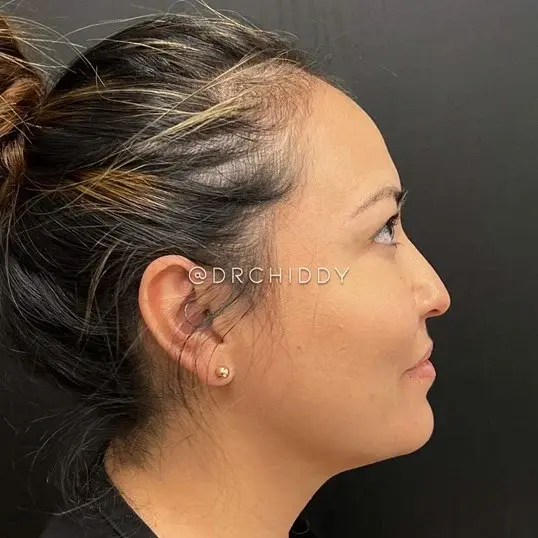 Jerry Chidester MD buccal fat removal after — Draper, UT