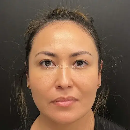Jerry Chidester MD buccal fat removal after — Draper, UT