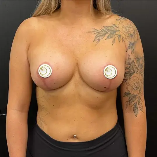 Jerry Chidester MD breast augmentation after — Draper, UT