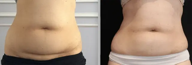 Thigh Lift result at Perfect Med Spa in New York, NY