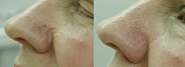 Laser Skin Resurfacing result at Perfect Med Spa in New York, NY