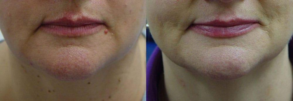Perfect Med Spa result — New York, NY
