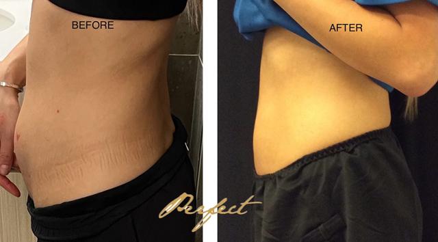Thigh Lift result at Perfect Med Spa in New York, NY