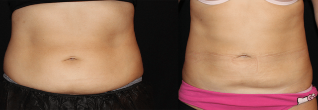 CoolSculpting result at Perfect Med Spa in New York, NY