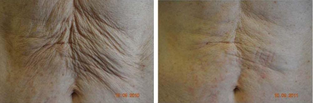 Perfect Med Spa result — New York, NY