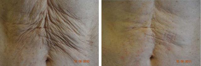 Morpheus8 result at Perfect Med Spa in New York, NY