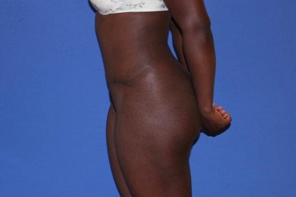 Dr. Joseph Michaels - Plastic Surgeon Rockville tummy tuck after — Rockville, MD