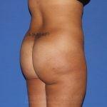 Brazilian Butt Lift after at Dr. Joseph Michaels - Plastic Surgeon Rockville in Rockville, MD