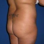Brazilian Butt Lift before at Dr. Joseph Michaels - Plastic Surgeon Rockville in Rockville, MD