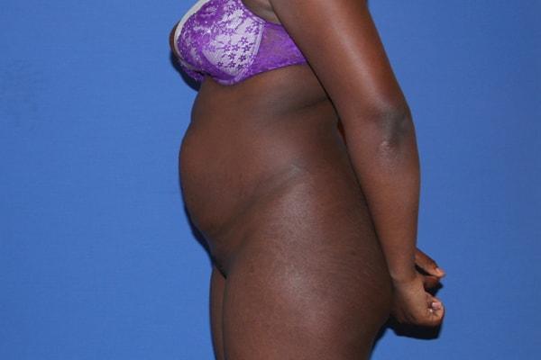 Mini Tummy Tuck before at Dr. Joseph Michaels - Plastic Surgeon Rockville in Rockville, MD