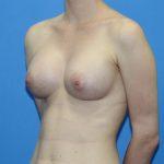 Fat Transfer Breast Augmentation after at Dr. Joseph Michaels - Plastic Surgeon Rockville in Rockville, MD