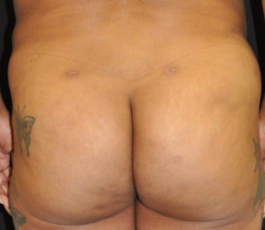 Northern Jersey Plastic Surgery Center bbl after โ Englewood, NJ