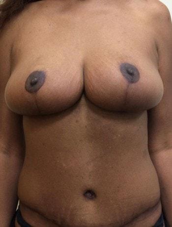 Northern Jersey Plastic Surgery Center mommy makeover after โ Englewood, NJ