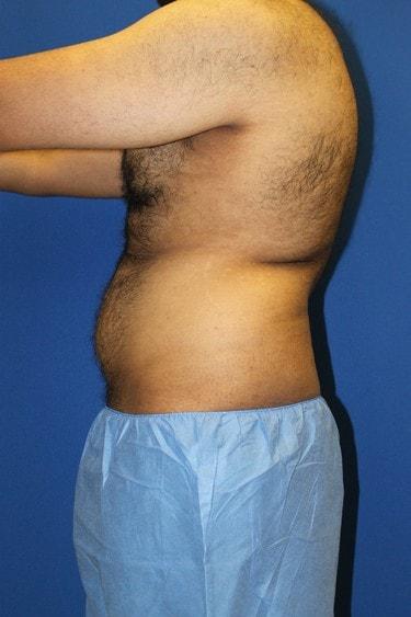 Liposuction before at Premier Cosmetic Surgery & Medispa in Seattle, WA