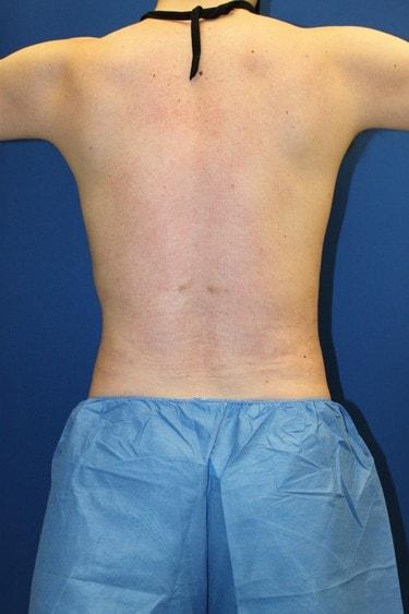 Liposuction after at Premier Cosmetic Surgery & Medispa in Seattle, WA