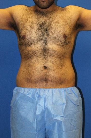 Liposuction after at Premier Cosmetic Surgery & Medispa in Seattle, WA