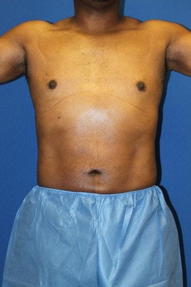 Liposuction after at Premier Cosmetic Surgery & Medispa in Seattle, WA