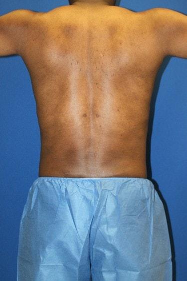 Liposuction after at Premier Cosmetic Surgery & Medispa in Seattle, WA