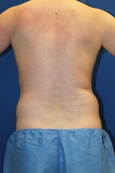 Liposuction before at Premier Cosmetic Surgery & Medispa in Seattle, WA