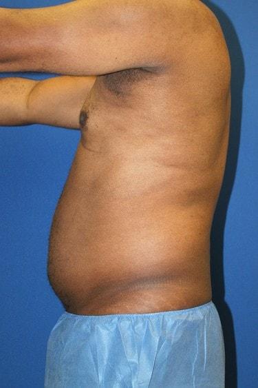 Liposuction before at Premier Cosmetic Surgery & Medispa in Seattle, WA