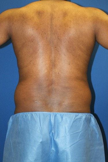 Liposuction before at Premier Cosmetic Surgery & Medispa in Seattle, WA