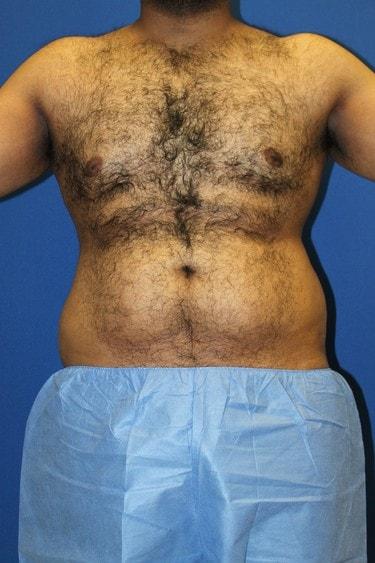 Liposuction before at Premier Cosmetic Surgery & Medispa in Seattle, WA
