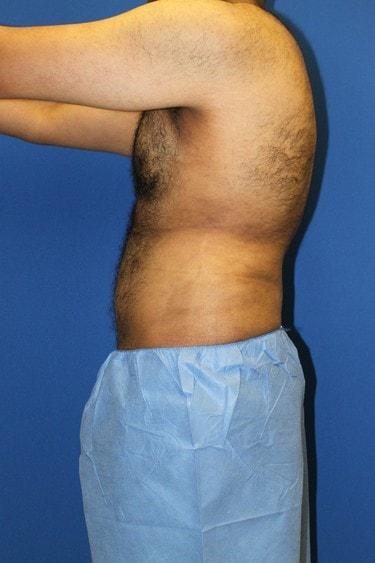 Liposuction after at Premier Cosmetic Surgery & Medispa in Seattle, WA