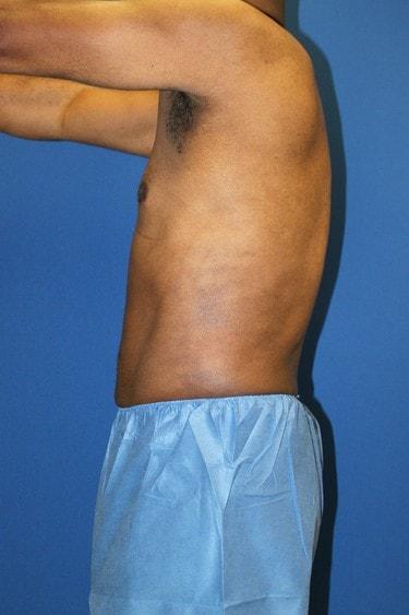 Liposuction after at Premier Cosmetic Surgery & Medispa in Seattle, WA