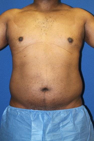 Liposuction before at Premier Cosmetic Surgery & Medispa in Seattle, WA