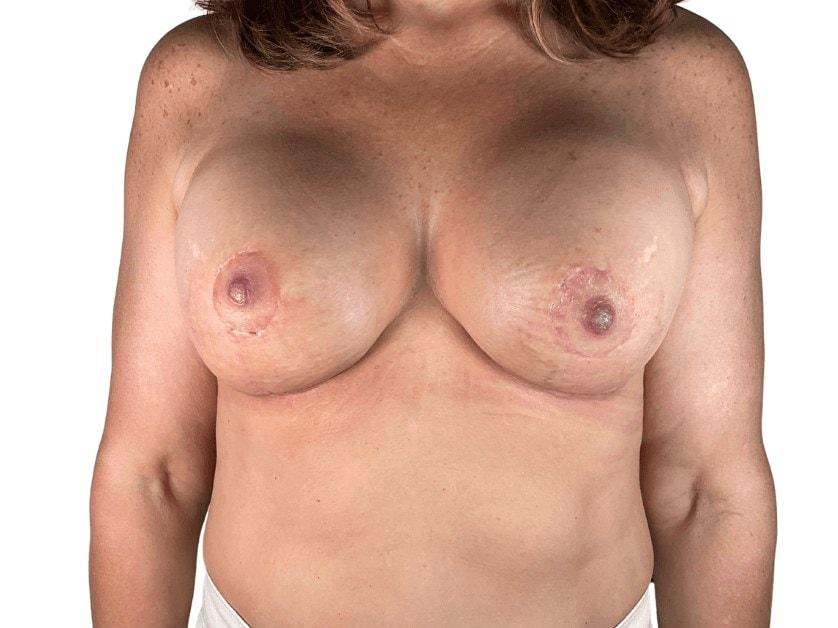 Panacea Plastic Surgery breast augmentation after — Atlanta, GA