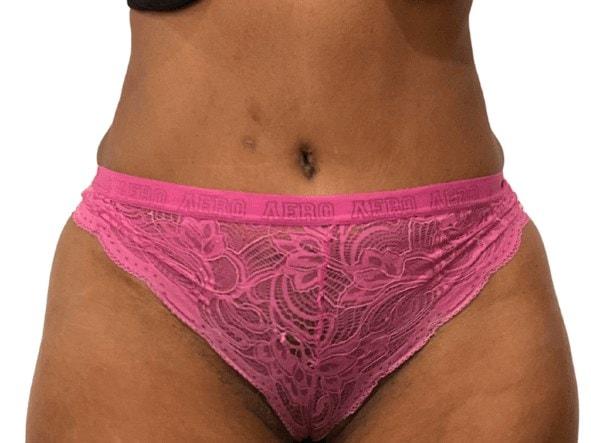 Panacea Plastic Surgery liposuction after — Atlanta, GA