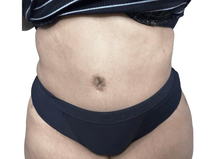 Panacea Plastic Surgery tummy tuck after — Atlanta, GA