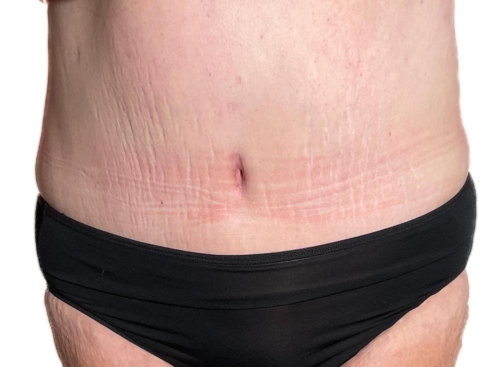 Panacea Plastic Surgery tummy tuck after — Atlanta, GA