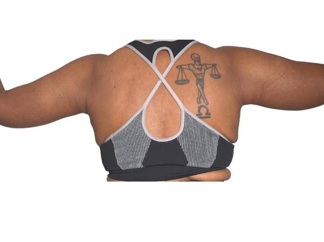 Arm Lift after at Panacea Plastic Surgery in Atlanta, GA