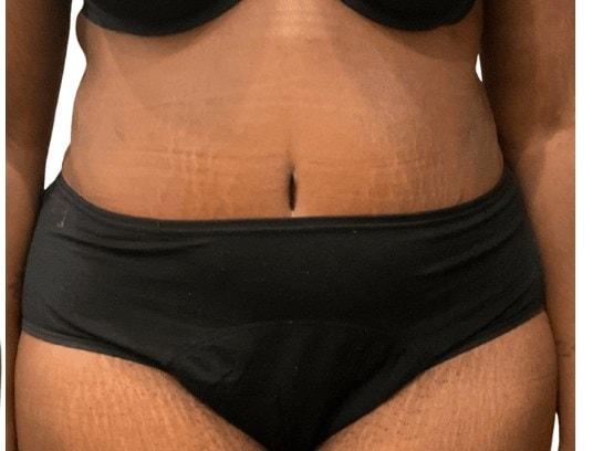 Panacea Plastic Surgery tummy tuck after — Atlanta, GA