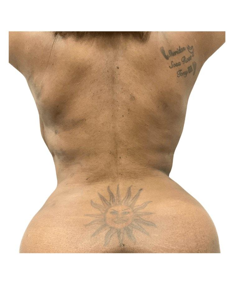 Panacea Plastic Surgery liposuction after — Atlanta, GA