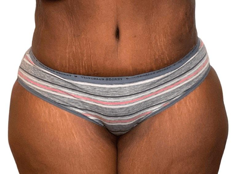Panacea Plastic Surgery tummy tuck after — Atlanta, GA