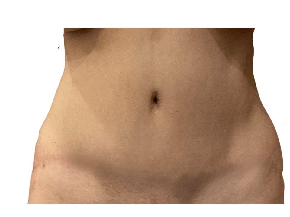 Panacea Plastic Surgery liposuction after — Atlanta, GA
