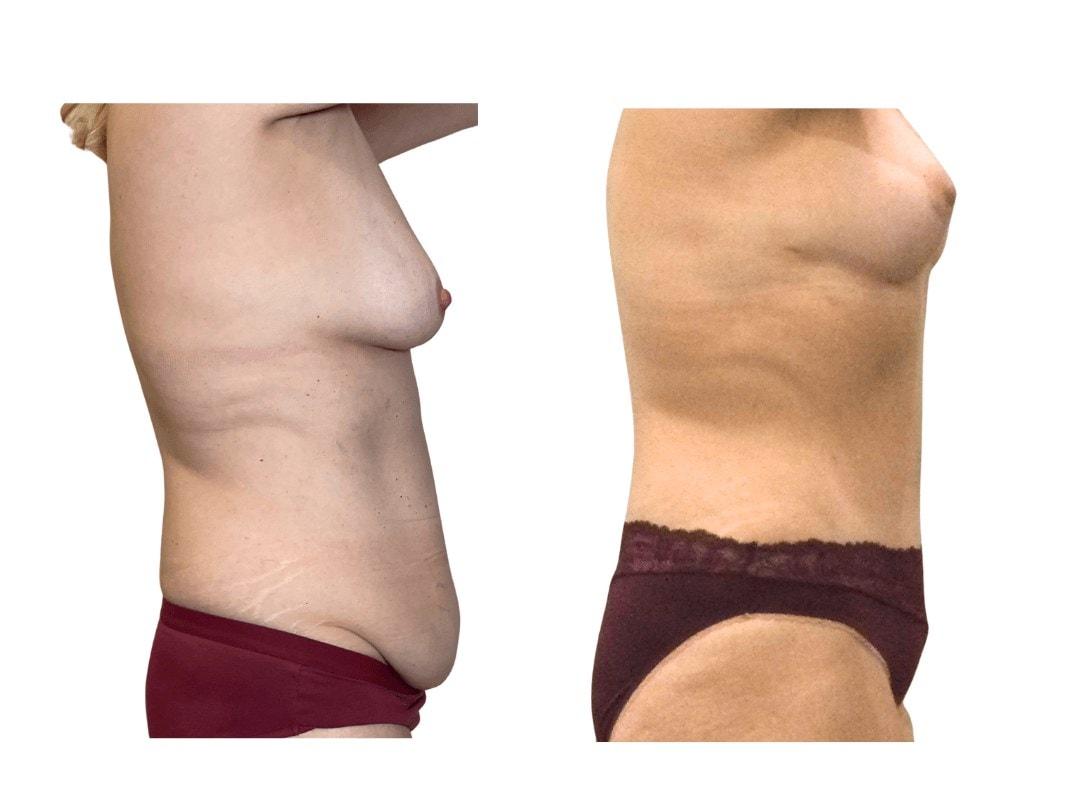 Panacea Plastic Surgery tummy tuck after — Atlanta, GA