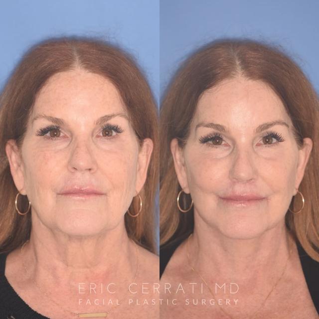 Brow Lift result at Eric W. Cerrati, MD, FACS in Salt Lake City, UT