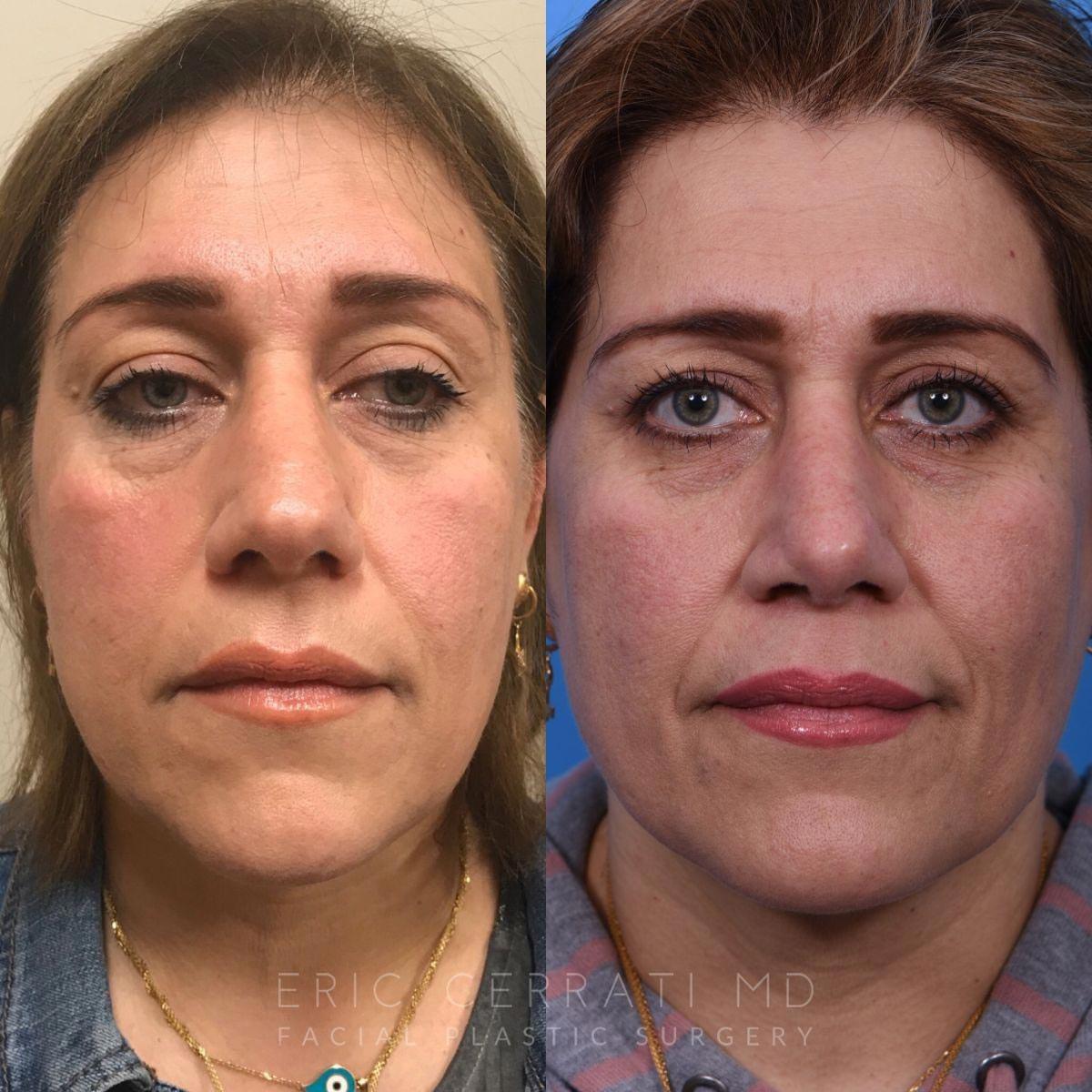 Eric W. Cerrati, MD, FACS rhinoplasty result — Salt Lake City, UT
