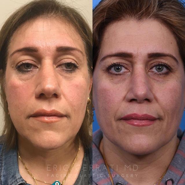 Functional Rhinoplasty result at Eric W. Cerrati, MD, FACS in Salt Lake City, UT