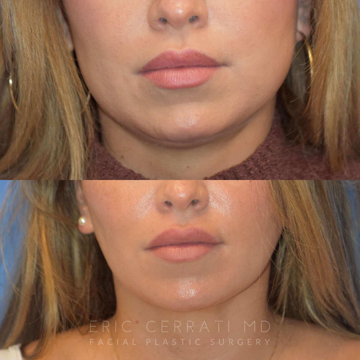 Eric W. Cerrati, MD, FACS buccal fat removal result — Salt Lake City, UT